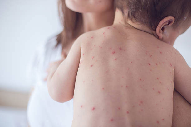 chickenpox in chickenpox